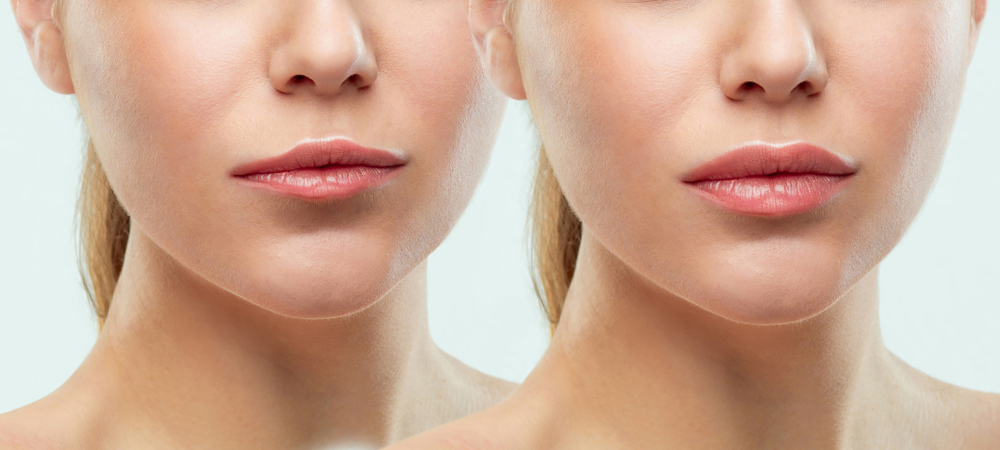 Permanent Lip Enhancement Procedure vs. Temporary Filler