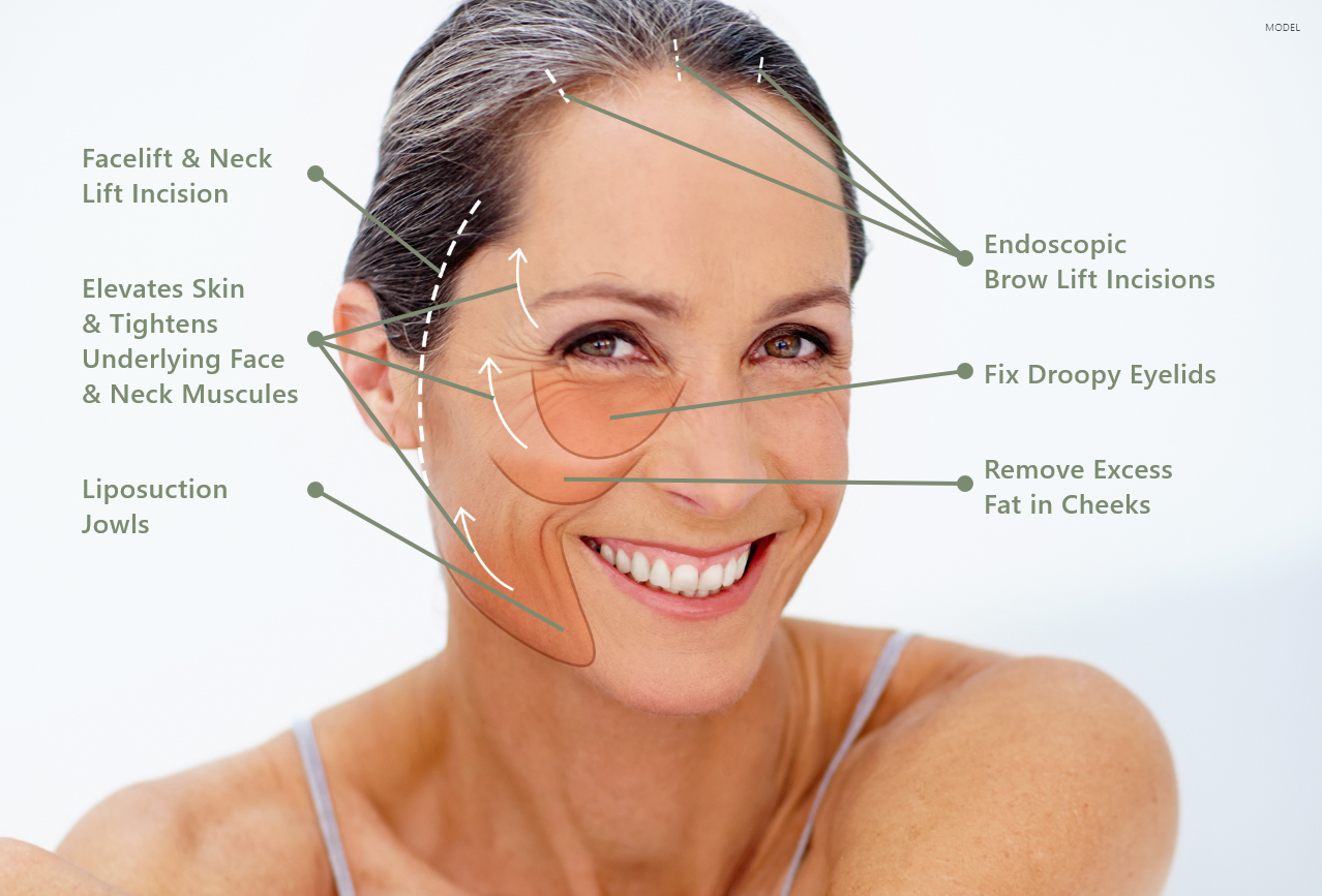 Incision marks for different procedures on the face
