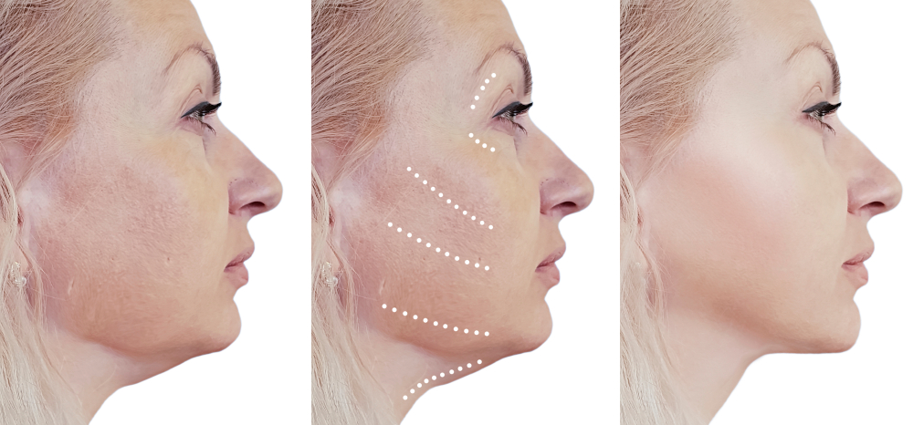 Facelift & Neck Lift in Denver