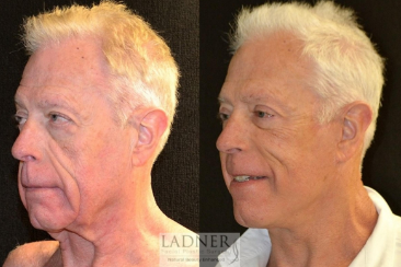 male facelift before and after