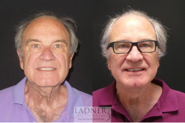 male facelift before and after