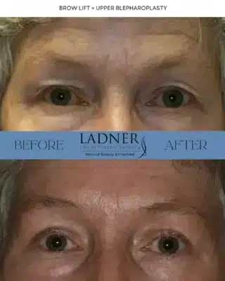 𝗕𝗥𝗢𝗪 𝗟𝗜𝗙𝗧 + 𝗨𝗣𝗣𝗘𝗥 𝗕𝗟𝗘𝗣𝗛𝗔𝗥𝗢𝗣𝗟𝗔𝗦𝗧𝗬 ✨This patient’s journey through a brow lift and upper blepharoplasty beautifully showcases how these procedures work in harmony. The brow lift elevates the brows, softening the deep forehead creases, while the upper blepharoplasty opens up the eyes for a more youthful and refreshed appearance. Together, they create a stunning transformation that highlights her natural beauty!To schedule a consultation with me at either of our locations in Denver or Beverly Hills, please call or email the office! I would love to be a part of your cosmetic journey, and I have an amazing team that will help set up your visit! ☎️📧—𝗟𝗔𝗗𝗡𝗘𝗥 𝗙𝗔𝗖𝗜𝗔𝗟 𝗣𝗟𝗔𝗦𝗧𝗜𝗖 𝗦𝗨𝗥𝗚𝗘𝗥𝗬𝘞𝘩𝘦𝘳𝘦 𝘕𝘢𝘵𝘶𝘳𝘢𝘭 𝘉𝘦𝘢𝘶𝘵𝘺 𝘪𝘴 𝘌𝘯𝘩𝘢𝘯𝘤𝘦𝘥 𝖢𝖺𝗅𝗅 𝗈𝗋 𝖤𝗆𝖺𝗂𝗅 𝗍𝗈 𝖲𝖼𝗁𝖾𝖽𝗎𝗅𝖾 𝖸𝗈𝗎𝗋 𝖢𝗈𝗇𝗌𝗎𝗅𝗍!𝗂𝗇𝖿𝗈＠𝖣𝗋𝖪𝖾𝗂𝗍𝗁𝖫𝖺𝖽𝗇𝖾𝗋.𝖼𝗈𝗆𝗗𝗲𝗻𝘃𝗲𝗿, 𝗖𝗼𝗹𝗼𝗿𝗮𝗱𝗼 𝟯𝟬𝟯-𝟮𝟱𝟯-𝟳𝟲𝟴𝟲𝗕𝗲𝘃𝗲𝗿𝗹𝘆 𝗛𝗶𝗹𝗹𝘀, 𝗖𝗮𝗹𝗶𝗳𝗼𝗿𝗻𝗶𝗮 𝟳𝟮𝟬-𝟳𝟭𝟬-𝟭𝟳𝟬𝟰......#plasticsurgeon #denverplasticsurgeon #denverplasticsurgery #denvercolorado #californiaplasticsurgeon #beverlyhillsplasticsurgeon #beverlyhillsplasticsurgery #chinaugmentation #facelift #necklift #blepharoplasty #eyelidsurgery #rhinoplasty #nosejob #submentalliposuction #browlift #foreheadlift #liplift#buccalfatremoval #facialfattransfer #otoplasty #earsurgery #beautifulskin #facialrejuvenation #facialenhancements #transformation #skincare #skincaregoals #CosmeticSurgery