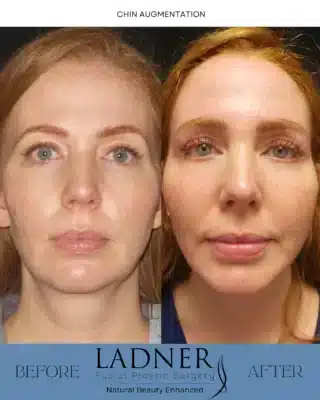 𝗖𝗛𝗜𝗡 𝗔𝗨𝗚𝗠𝗘𝗡𝗧𝗔𝗧𝗜𝗢𝗡 💫This patient underwent chin augmentation to enhance facial harmony and bring proportion to her lower third. Often overlooked, the chin plays a critical role in facial balance — especially in relation to the nose, jawline, and overall profile.In her case, a conservative approach was taken to improve projection and definition without creating an overdone or artificial look. The result? A more contoured jawline, improved side profile, and a natural enhancement that complements her unique features. Chin augmentation is an excellent option for patients who feel their chin appears recessed or lacks definition. Whether surgical or non-surgical, treatment can help create symmetry, refine contours, and support a more youthful, confident appearance.To schedule a consultation with me at either of our locations in Denver or Beverly Hills, please call or email the office! I would love to be a part of your cosmetic journey, and I have an amazing team that will help set up your visit! ☎️📧—𝗟𝗔𝗗𝗡𝗘𝗥 𝗙𝗔𝗖𝗜𝗔𝗟 𝗣𝗟𝗔𝗦𝗧𝗜𝗖 𝗦𝗨𝗥𝗚𝗘𝗥𝗬𝘞𝘩𝘦𝘳𝘦 𝘕𝘢𝘵𝘶𝘳𝘢𝘭 𝘉𝘦𝘢𝘶𝘵𝘺 𝘪𝘴 𝘌𝘯𝘩𝘢𝘯𝘤𝘦𝘥 𝖢𝖺𝗅𝗅 𝗈𝗋 𝖤𝗆𝖺𝗂𝗅 𝗍𝗈 𝖲𝖼𝗁𝖾𝖽𝗎𝗅𝖾 𝖸𝗈𝗎𝗋 𝖢𝗈𝗇𝗌𝗎𝗅𝗍!𝗂𝗇𝖿𝗈＠𝖣𝗋𝖪𝖾𝗂𝗍𝗁𝖫𝖺𝖽𝗇𝖾𝗋.𝖼𝗈𝗆𝗗𝗲𝗻𝘃𝗲𝗿, 𝗖𝗼𝗹𝗼𝗿𝗮𝗱𝗼 𝟯𝟬𝟯-𝟮𝟱𝟯-𝟳𝟲𝟴𝟲𝗕𝗲𝘃𝗲𝗿𝗹𝘆 𝗛𝗶𝗹𝗹𝘀, 𝗖𝗮𝗹𝗶𝗳𝗼𝗿𝗻𝗶𝗮 𝟳𝟮𝟬-𝟳𝟭𝟬-𝟭𝟳𝟬𝟰......#plasticsurgeon #denverplasticsurgeon #denverplasticsurgery #denvercolorado #californiaplasticsurgeon #beverlyhillsplasticsurgeon #beverlyhillsplasticsurgery #chinaugmentation #facelift #necklift #blepharoplasty #eyelidsurgery #rhinoplasty #nosejob #submentalliposuction #browlift #foreheadlift #liplift#buccalfatremoval #facialfattransfer #otoplasty #earsurgery #beautifulskin #facialrejuvenation #facialenhancements #transformation #skincare #skincaregoals #CosmeticSurgery