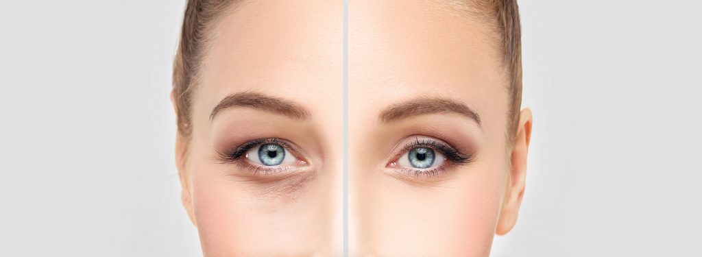 Ptosis Repair Surgery Denver