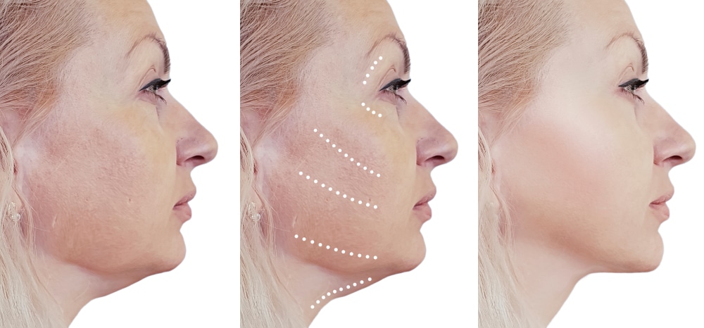 Facelift & Neck Lift in Denver