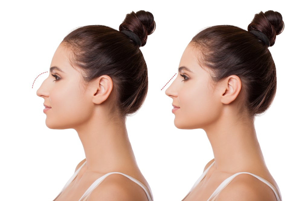 before and after diagram of rhinoplasty with line showing change in shape