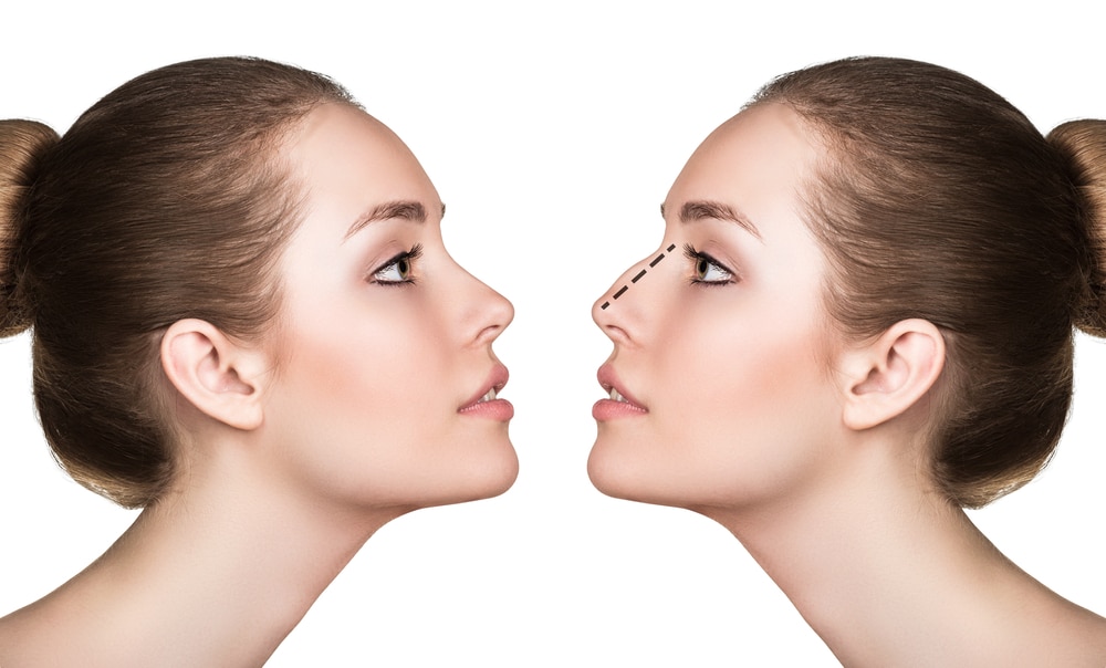 Rhinoplasty in Boulder