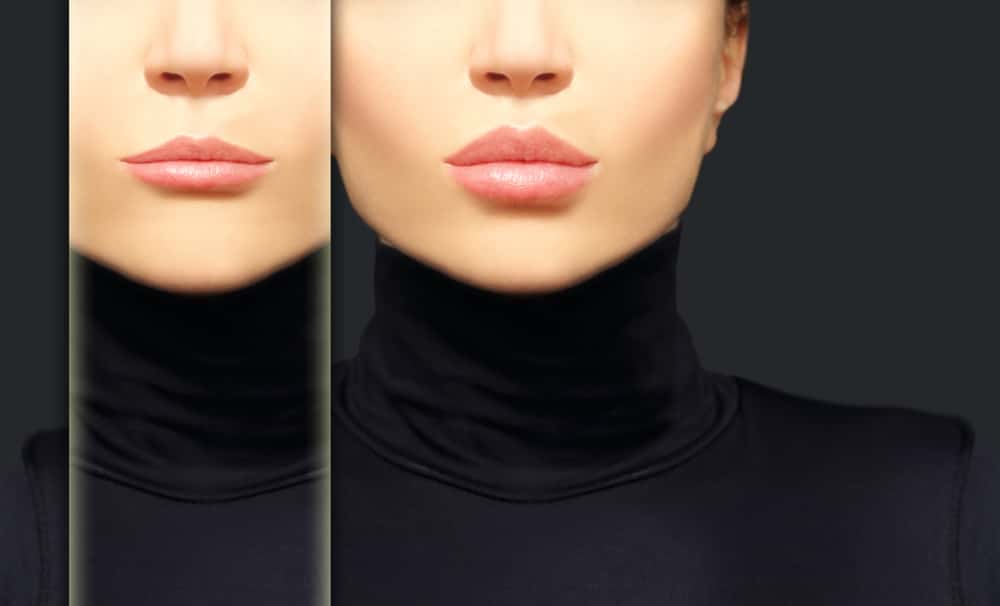 Restylane KYSSE: A New Long Lasting Lip Filler.