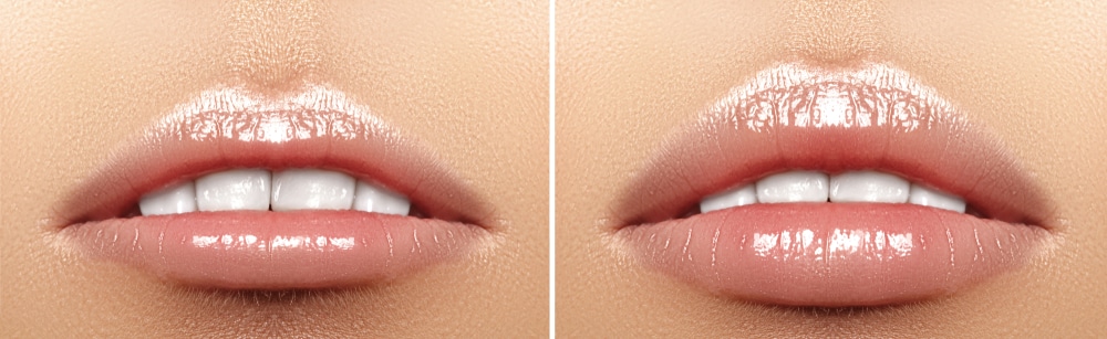 Learn more in this post about Restylane KYSSE.