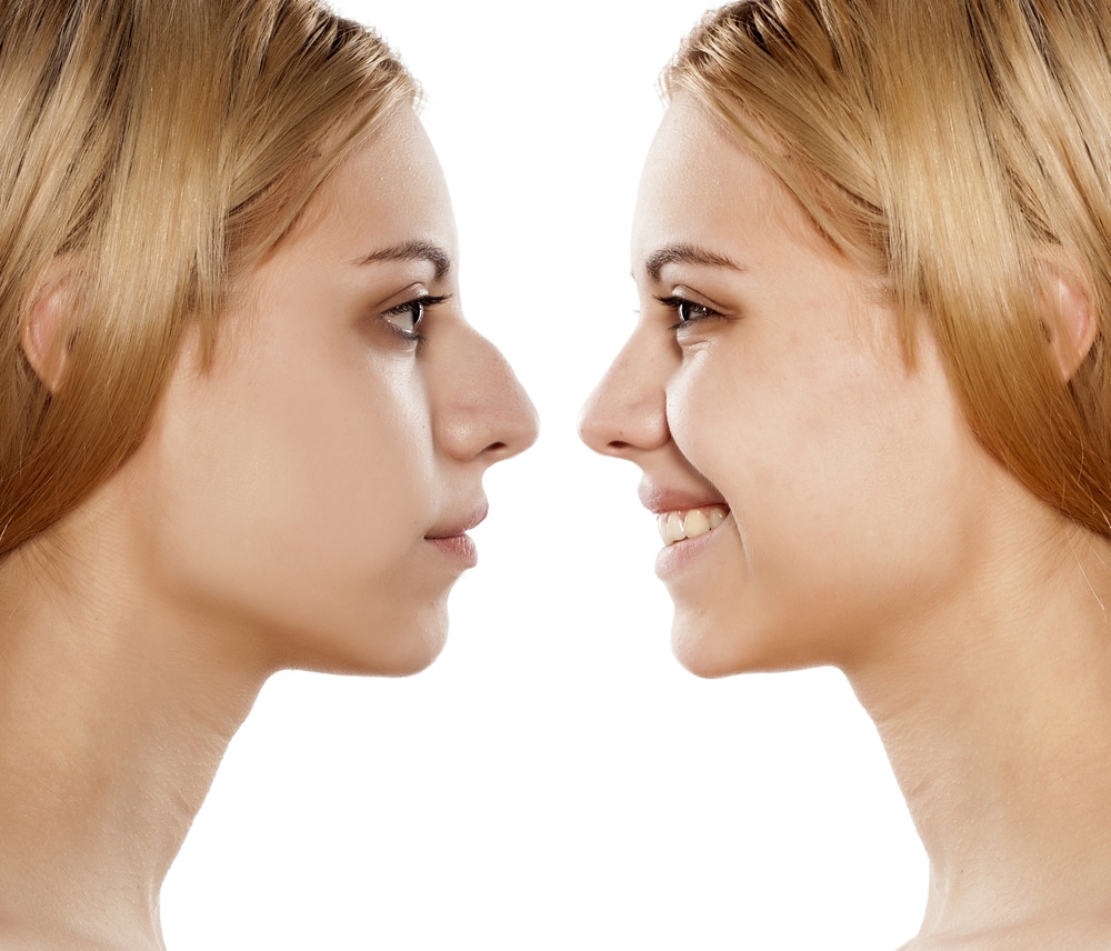 Rhinoplasty vs. Rhinoplasty Revision in Denver