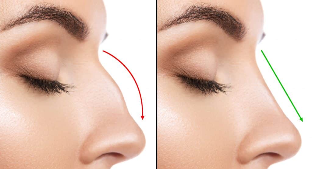 Surgical vs. Non Surgical Nose Jobs. 