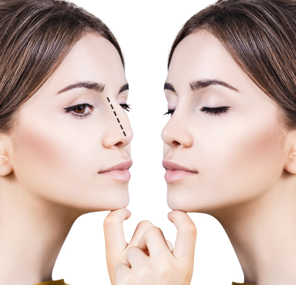 Nose Job Doctor in Denver