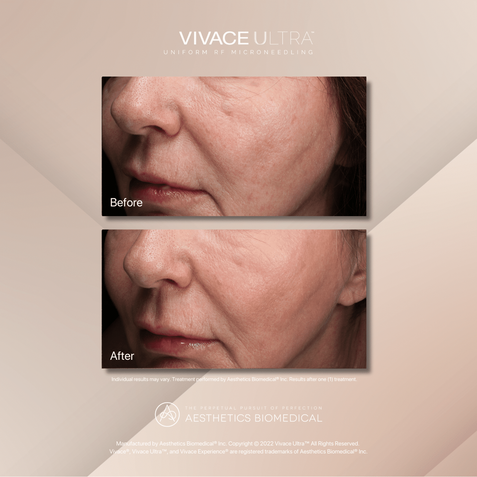 microneedling denver