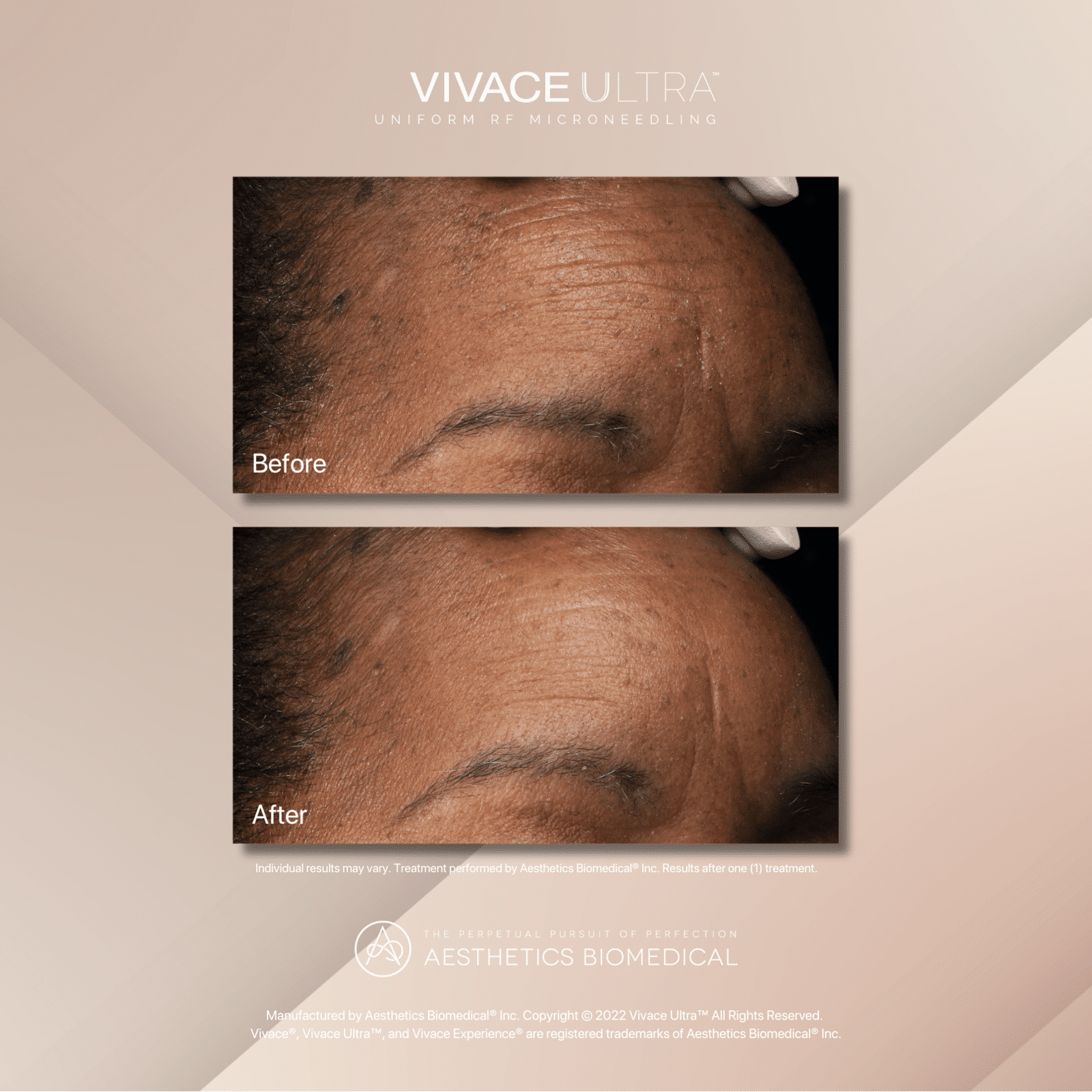 vivace before and after