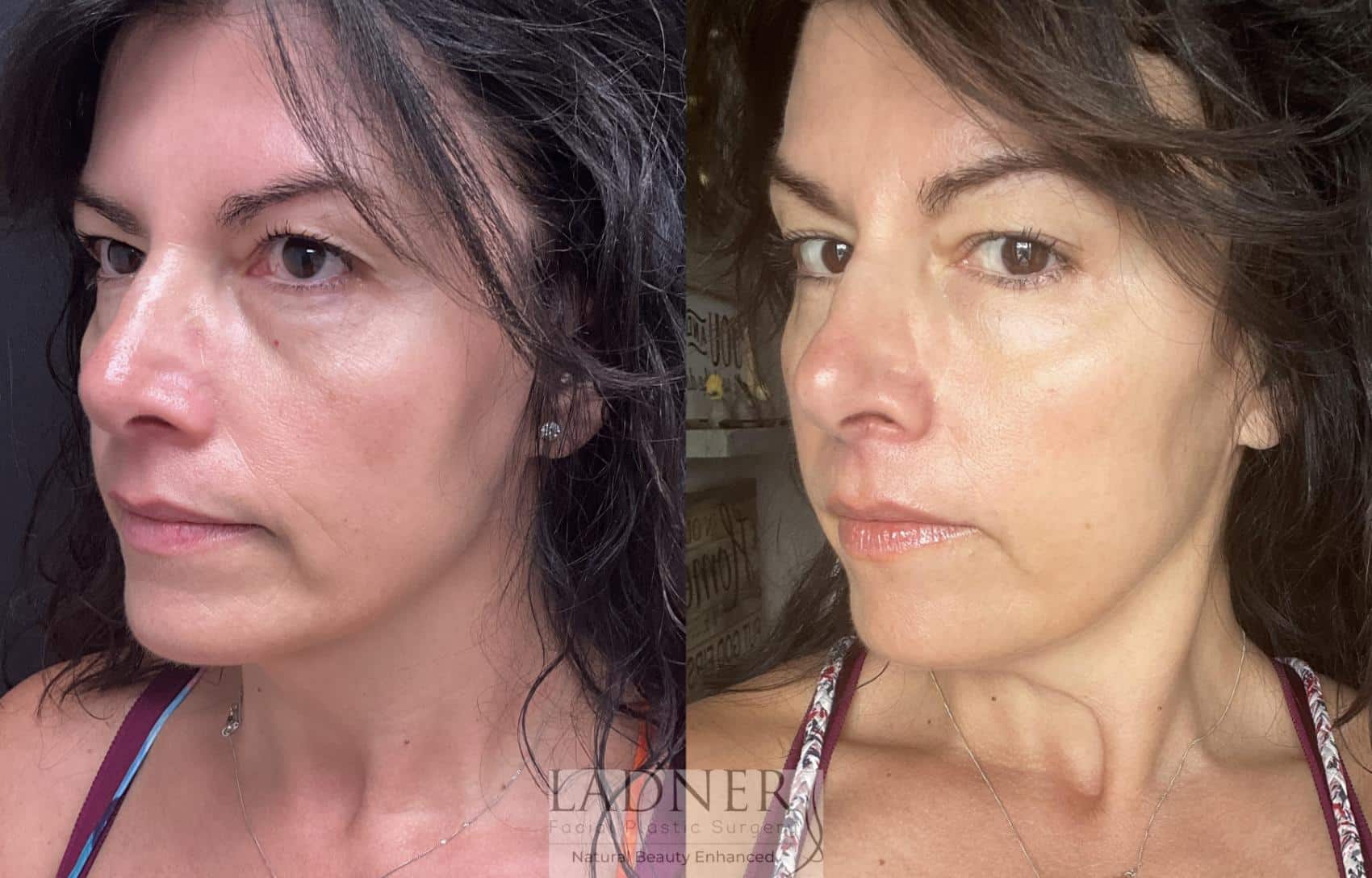 Facial Balancing Case 205 Before & After Left Oblique | Denver, CO | Ladner Facial Plastic Surgery