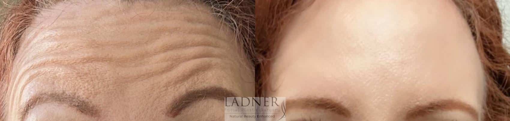 Botox/Dysport Case 162 Before & After Front | Denver, CO | Ladner Facial Plastic Surgery
