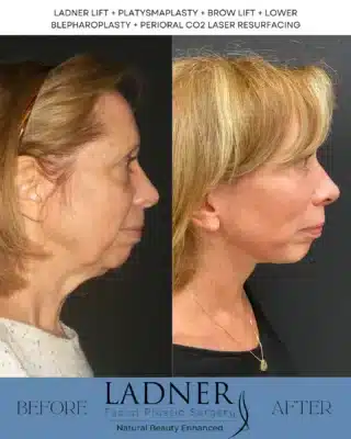 𝗟𝗔𝗗𝗡𝗘𝗥 𝗟𝗜𝗙𝗧 + 𝗠𝗨𝗟𝗧𝗜 𝗣𝗥𝗢𝗖𝗘𝗗𝗨𝗥𝗘𝗦My patient recently underwent the Ladner Lift, complemented by a platysmaplasty, brow lift, lower blepharoplasty, and perioral CO2 laser resurfacing! Each procedure was meticulously designed to enhance her natural features:𝗟𝗮𝗱𝗻𝗲𝗿 𝗟𝗶𝗳𝘁: Provides a rejuvenated contour to the  face, restoring youthful volume and structure.𝗣𝗹𝗮𝘁𝘆𝘀𝗺𝗮𝗽𝗹𝗮𝘀𝘁𝘆: Tightens the neck area, eliminating sagging skin for a smoother profile.𝗕𝗿𝗼𝘄 𝗟𝗶𝗳𝘁: Elevates the brow, opening up the eyes and creating a more alert appearance.𝗟𝗼𝘄𝗲𝗿 𝗕𝗹𝗲𝗽𝗵𝗮𝗿𝗼𝗽𝗹𝗮𝘀𝘁𝘆: Eliminates puffiness and dark circles, enhancing the overall eye area.𝗣𝗲𝗿𝗶𝗼𝗿𝗮𝗹 𝗖𝗢𝟮 𝗟𝗮𝘀𝗲𝗿 𝗥𝗲𝘀𝘂𝗿𝗳𝗮𝗰𝗶𝗻𝗴: Smooths the skin around the mouth, reducing fine lines and adding radiance.The results? A beautifully refreshed look that can easily take off 10-15 years! It’s incredibly rewarding to witness such a remarkable boost in confidence and vitality. To schedule a consultation with me at either of our locations in Denver or Beverly Hills, please call or email the office! I would love to be a part of your cosmetic journey, and I have an amazing team that will help set up your visit! ☎️📧—𝗟𝗔𝗗𝗡𝗘𝗥 𝗙𝗔𝗖𝗜𝗔𝗟 𝗣𝗟𝗔𝗦𝗧𝗜𝗖 𝗦𝗨𝗥𝗚𝗘𝗥𝗬𝘞𝘩𝘦𝘳𝘦 𝘕𝘢𝘵𝘶𝘳𝘢𝘭 𝘉𝘦𝘢𝘶𝘵𝘺 𝘪𝘴 𝘌𝘯𝘩𝘢𝘯𝘤𝘦𝘥 𝖢𝖺𝗅𝗅 𝗈𝗋 𝖤𝗆𝖺𝗂𝗅 𝗍𝗈 𝖲𝖼𝗁𝖾𝖽𝗎𝗅𝖾 𝖸𝗈𝗎𝗋 𝖢𝗈𝗇𝗌𝗎𝗅𝗍!𝗂𝗇𝖿𝗈＠𝖣𝗋𝖪𝖾𝗂𝗍𝗁𝖫𝖺𝖽𝗇𝖾𝗋.𝖼𝗈𝗆𝗗𝗲𝗻𝘃𝗲𝗿, 𝗖𝗼𝗹𝗼𝗿𝗮𝗱𝗼 𝟯𝟬𝟯-𝟮𝟱𝟯-𝟳𝟲𝟴𝟲𝗕𝗲𝘃𝗲𝗿𝗹𝘆 𝗛𝗶𝗹𝗹𝘀, 𝗖𝗮𝗹𝗶𝗳𝗼𝗿𝗻𝗶𝗮 𝟳𝟮𝟬-𝟳𝟭𝟬-𝟭𝟳𝟬𝟰......#plasticsurgeon #denverplasticsurgeon #denverplasticsurgery #denvercolorado #californiaplasticsurgeon #beverlyhillsplasticsurgeon #beverlyhillsplasticsurgery #chinaugmentation #facelift #necklift #blepharoplasty #eyelidsurgery #rhinoplasty #nosejob #submentalliposuction #browlift #foreheadlift #liplift#buccalfatremoval #facialfattransfer #otoplasty #earsurgery #beautifulskin #facialrejuvenation #facialenhancements #transformation #skincare #skincaregoals #CosmeticSurgery