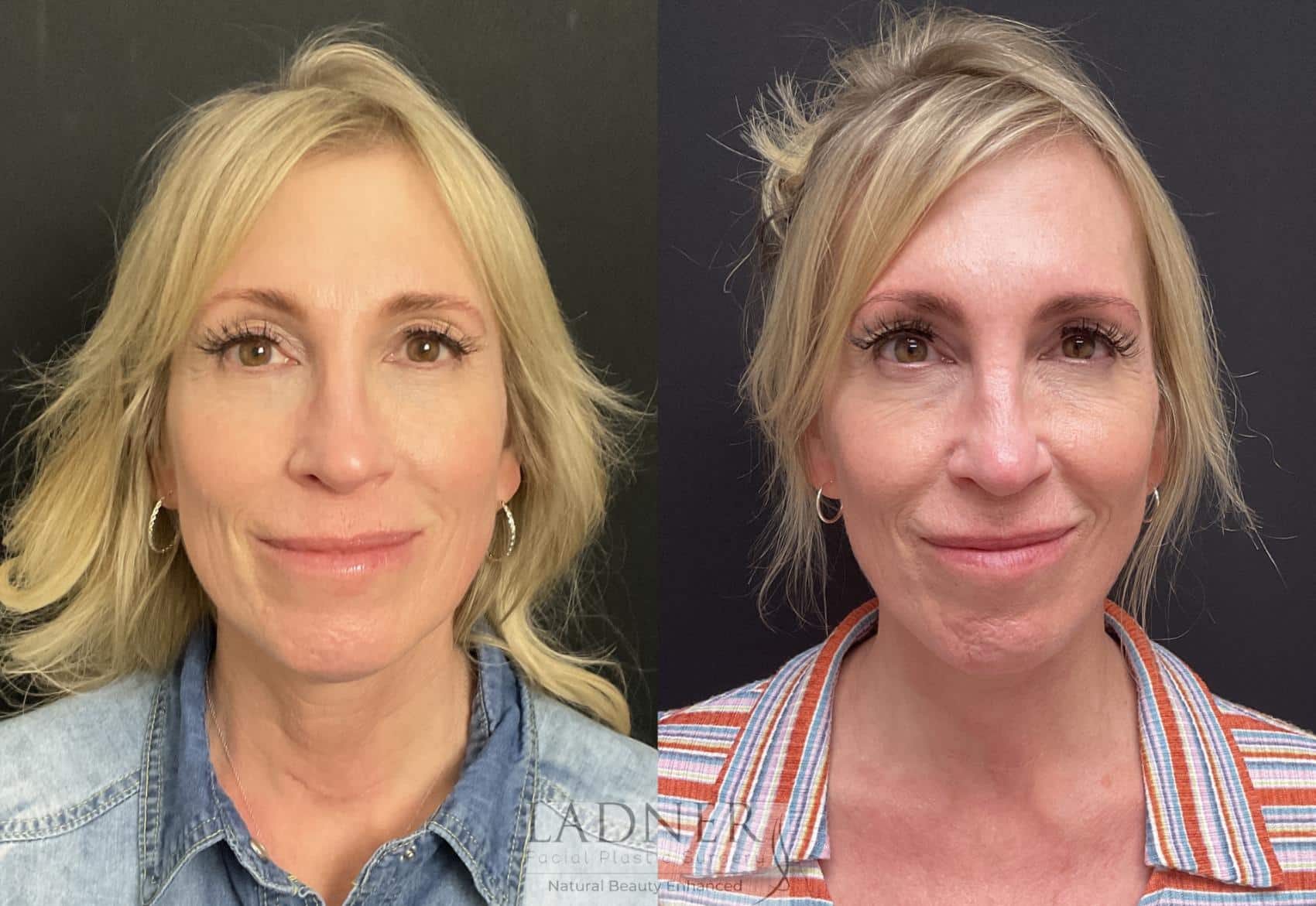 Deep Plane Facelift / Neck Lift Case 206 Before & After Front | Denver, CO | Ladner Facial Plastic Surgery