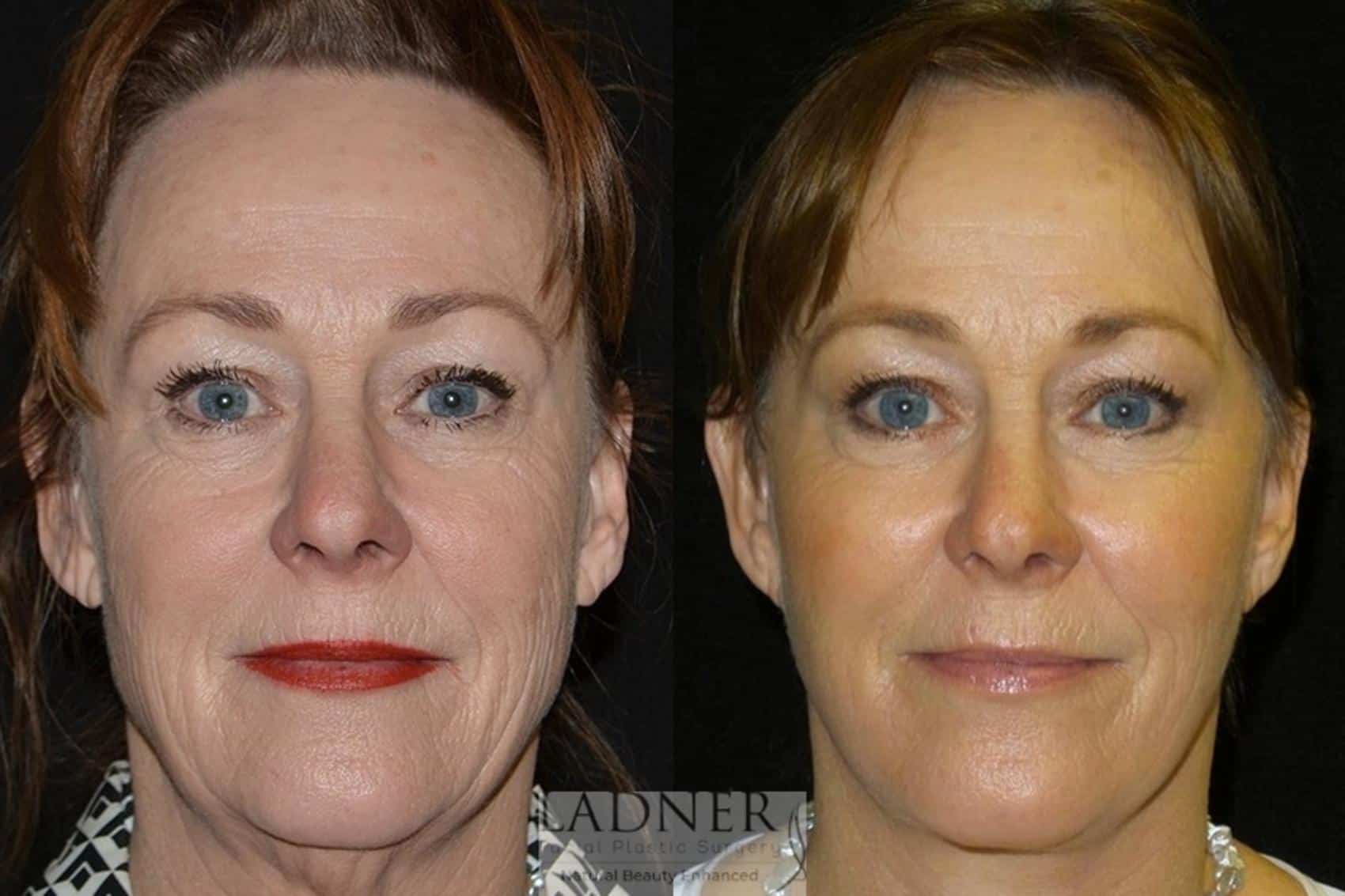 Skin Treatments Case 37 Before & After Front | Denver, CO | Ladner Facial Plastic Surgery