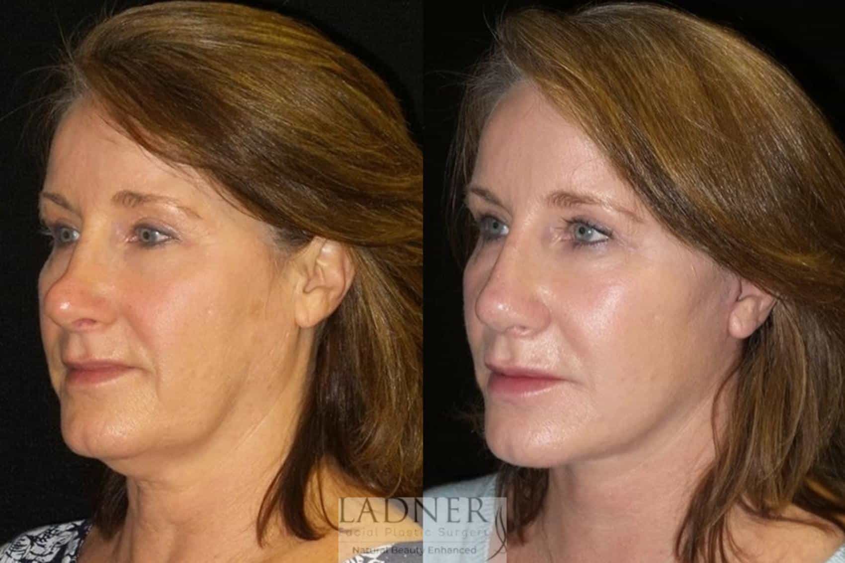 Deep Plane Facelift / Neck Lift Case 36 Before & After Left Oblique | Denver, CO | Ladner Facial Plastic Surgery