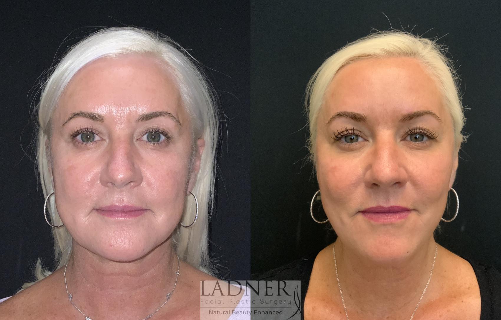 Facial Balancing Case 221 Before & After Front | Denver, CO | Ladner Facial Plastic Surgery