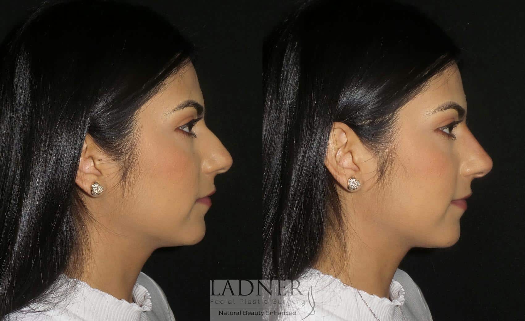 Facial Balancing Case 180 Before & After Right Side | Denver, CO | Ladner Facial Plastic Surgery