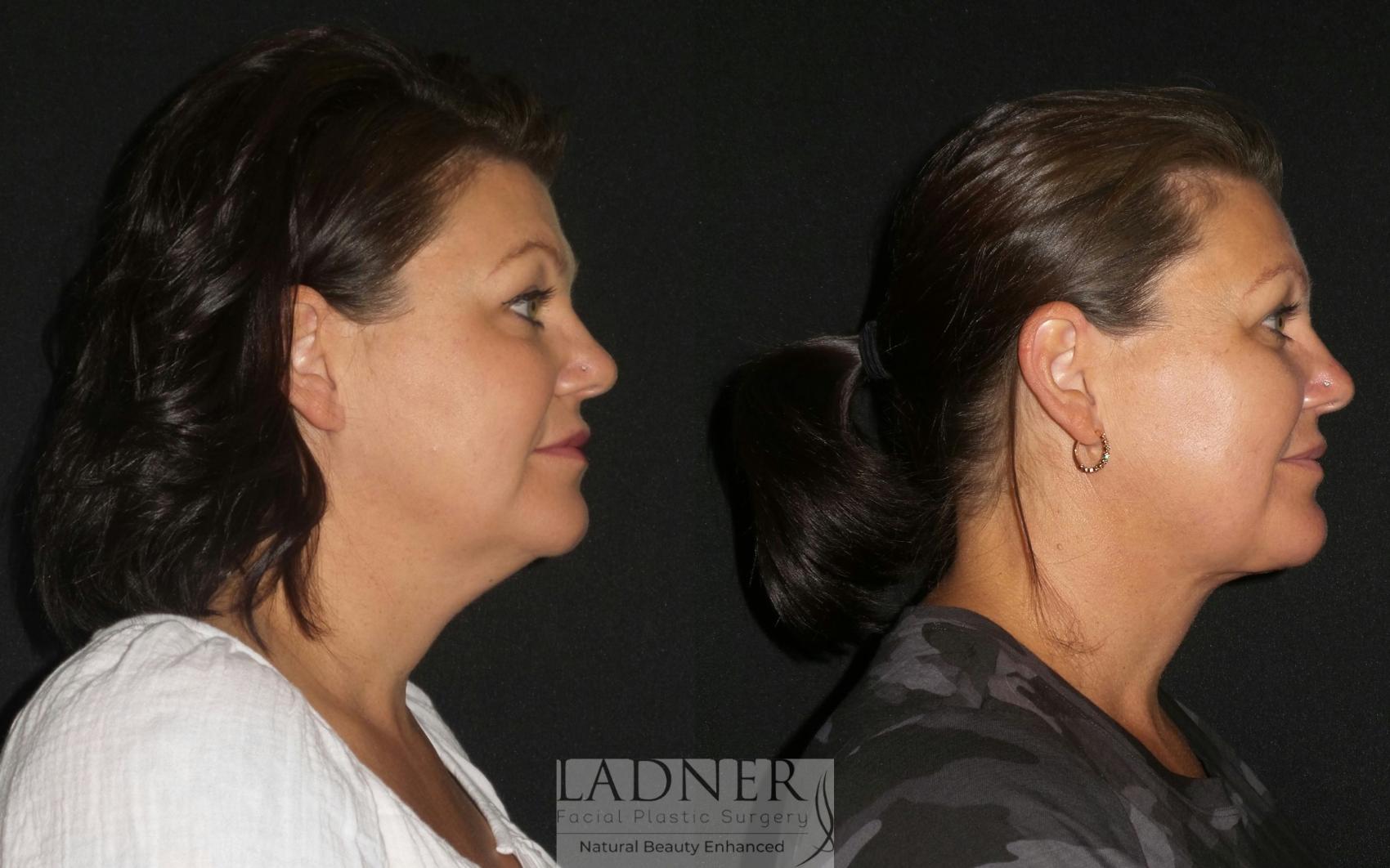 Before Submental & Submandibular Liposuction