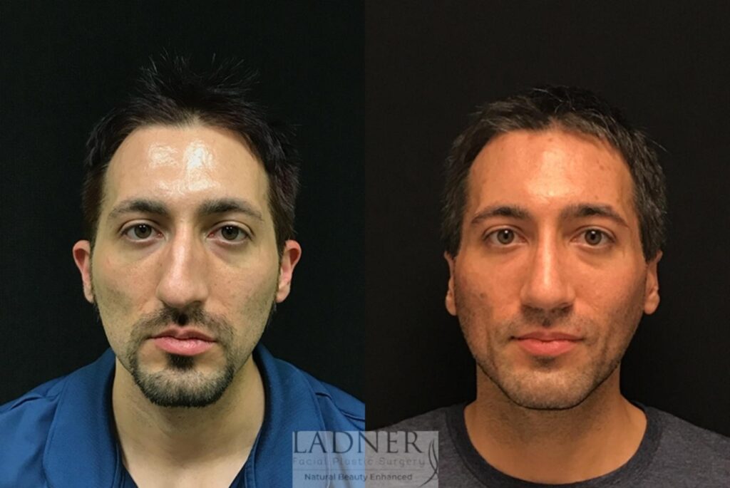 1753896618_facial-plastic-surgery-for-men-18-front-detail