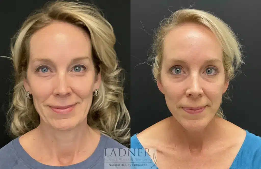 Before and After Image: Deep Plane Facelift & Blepharoplasty - front