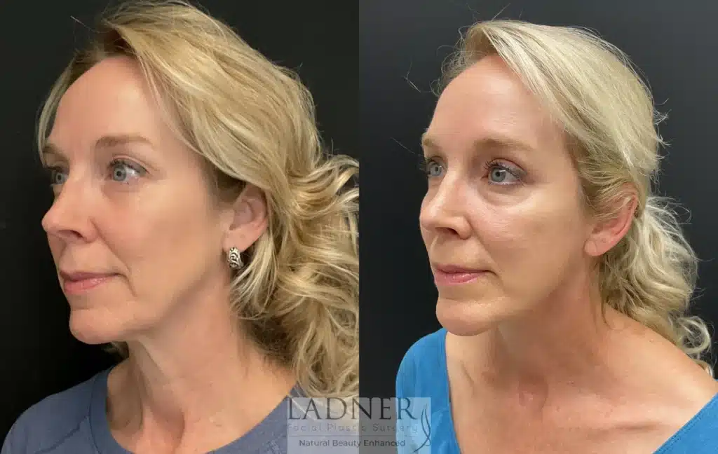 Before and After Image: Deep Plane Facelift & Blepharoplasty - left-front-oblique