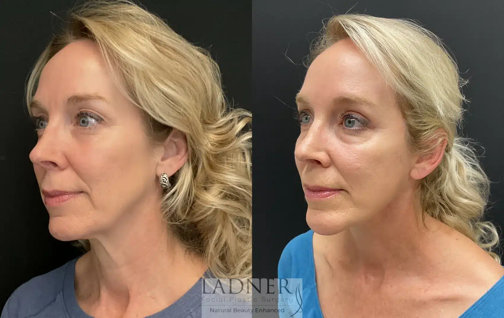 Before and After Image: Deep Plane Facelift - left-front-oblique