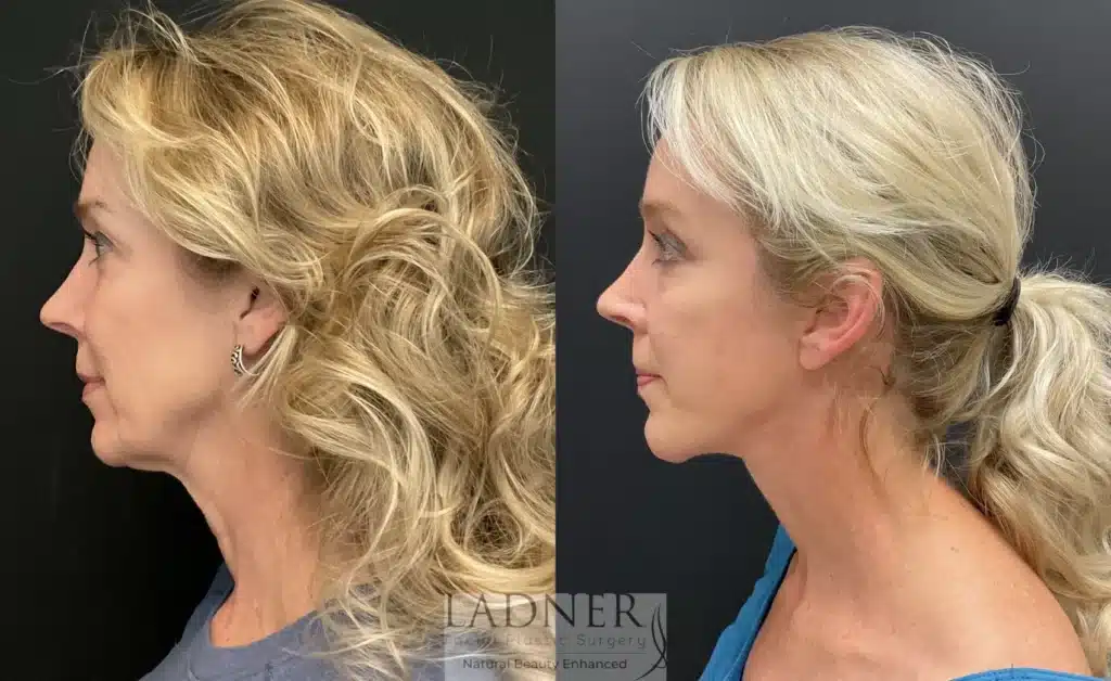 Before and After Image: Deep Plane Facelift & Blepharoplasty - left-front-oblique