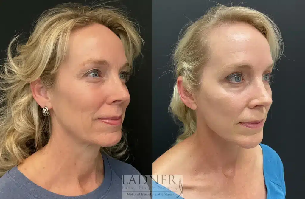 Before and After Image: Deep Plane Facelift & Blepharoplasty - right-front-oblique