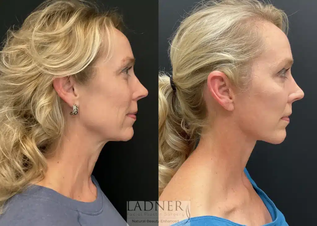 Before and After Image: Deep Plane Facelift & Blepharoplasty - right-side