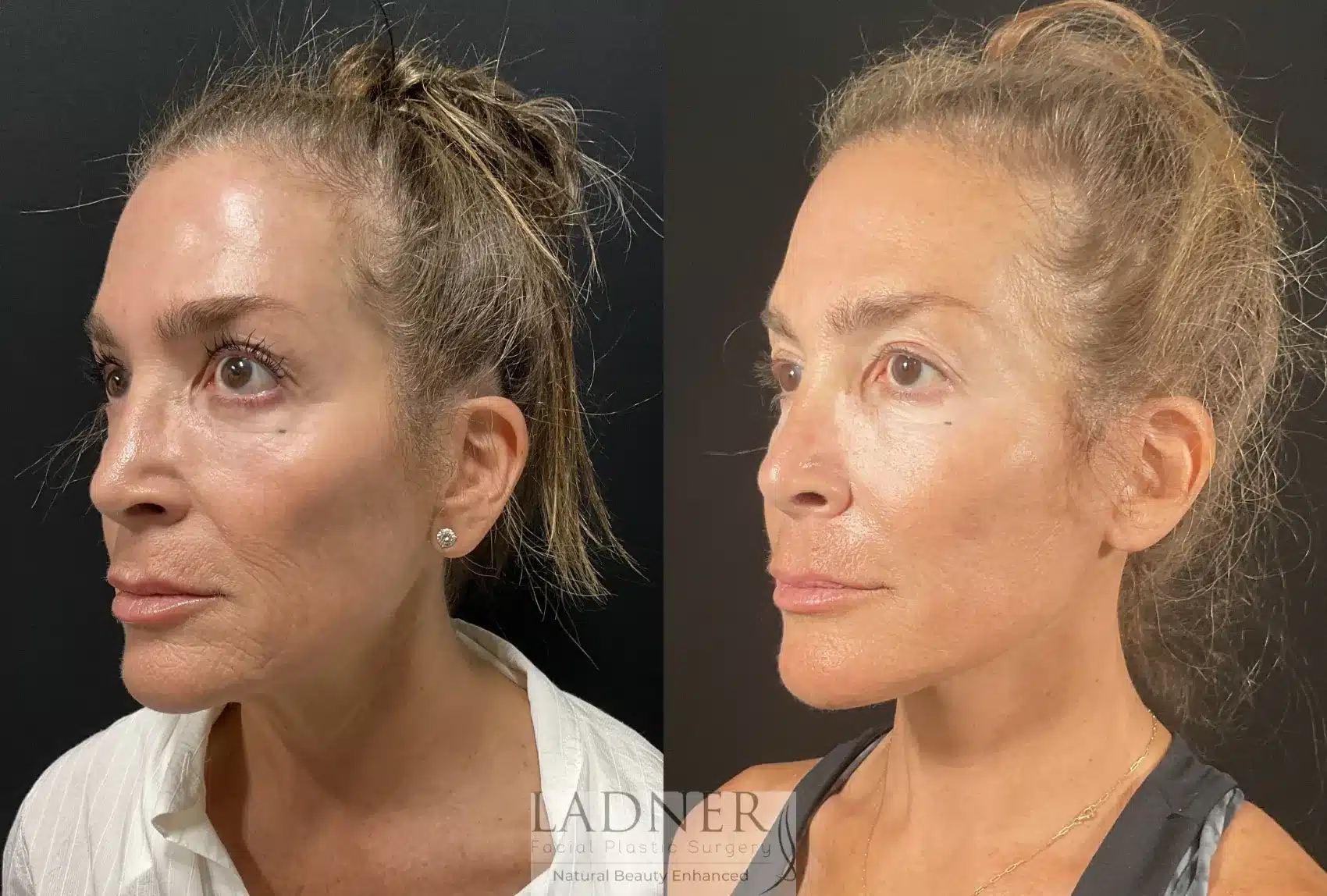 Before and After Image: Deep Plane Facelift - left-front-oblique