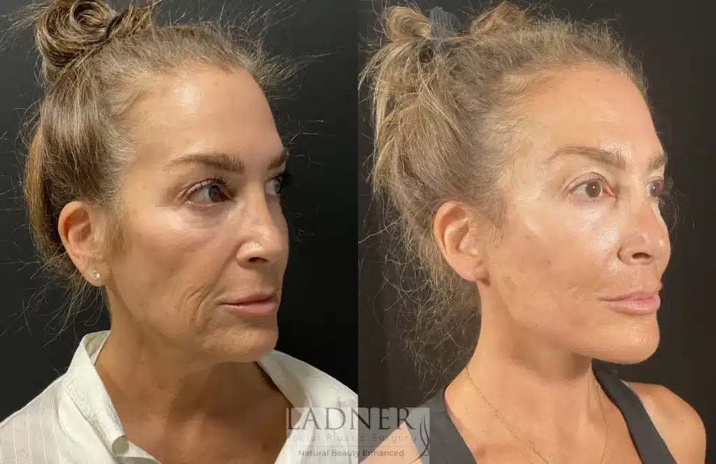 Before and After Image: Skin Treatments - right-front-oblique