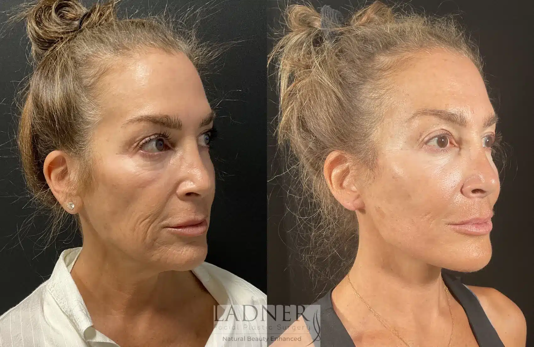 Before and After Image: Deep Plane Facelift - right-front-oblique