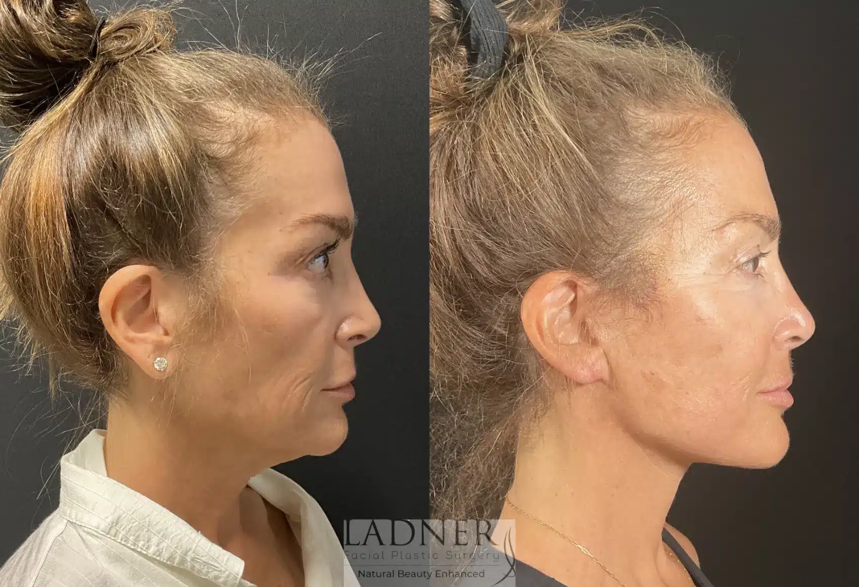 Before and After Image: Deep Plane Facelift - right-side