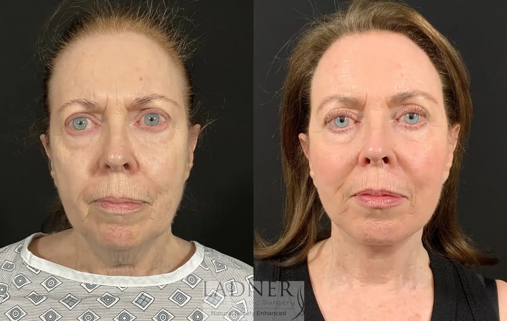 Before and After Image: Deep Plane Face Lift/Neck Lift - front