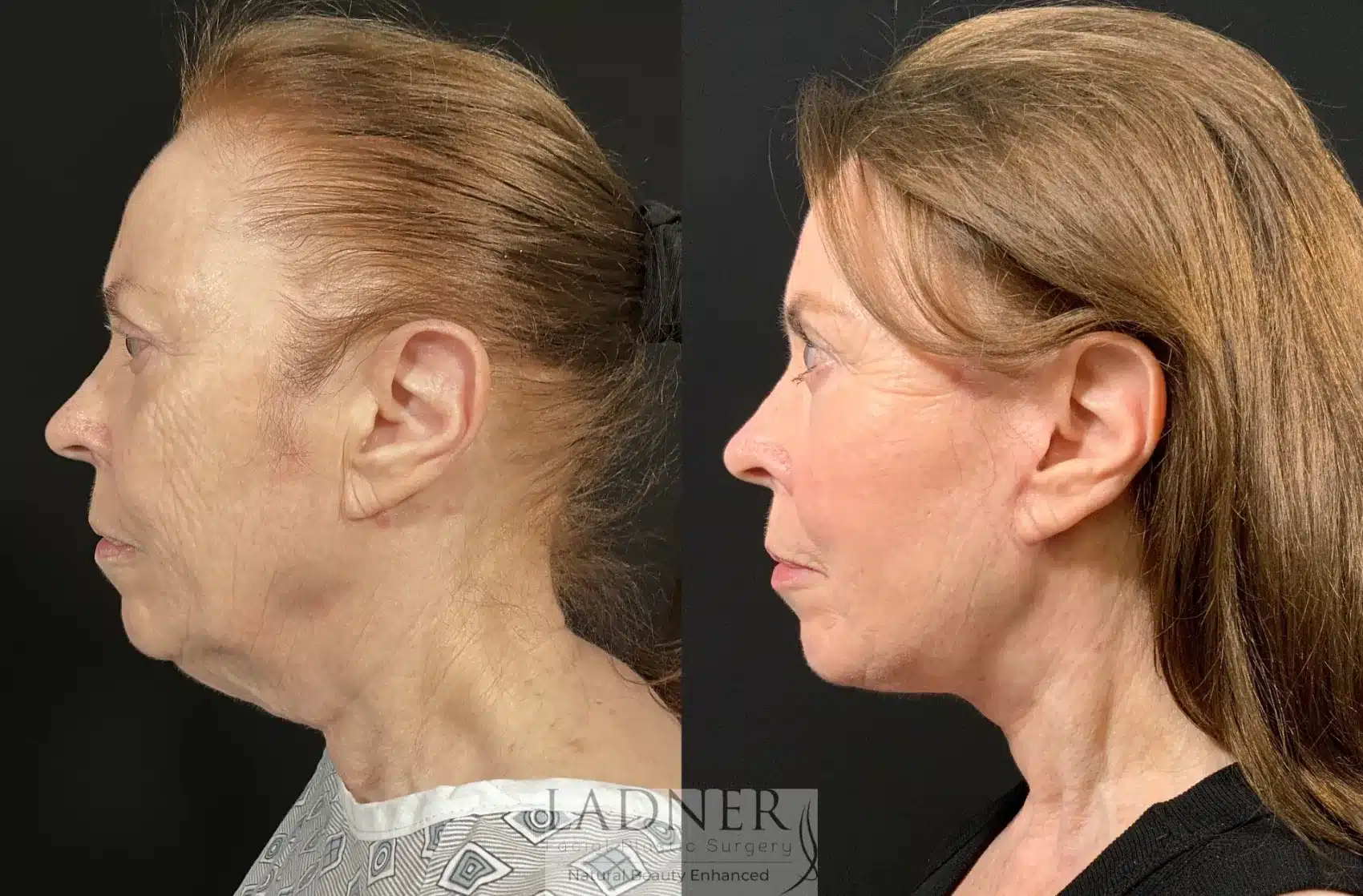 Before and After Image: Deep Plane Face Lift/Neck Lift - left-side