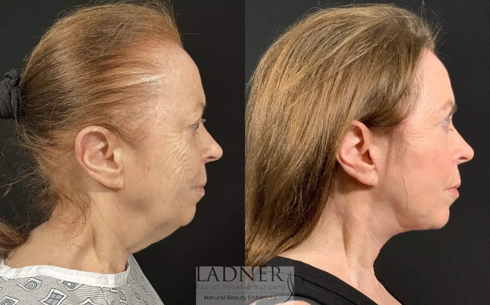 Before and After Image: Deep Plane Face Lift/Neck Lift - right-side