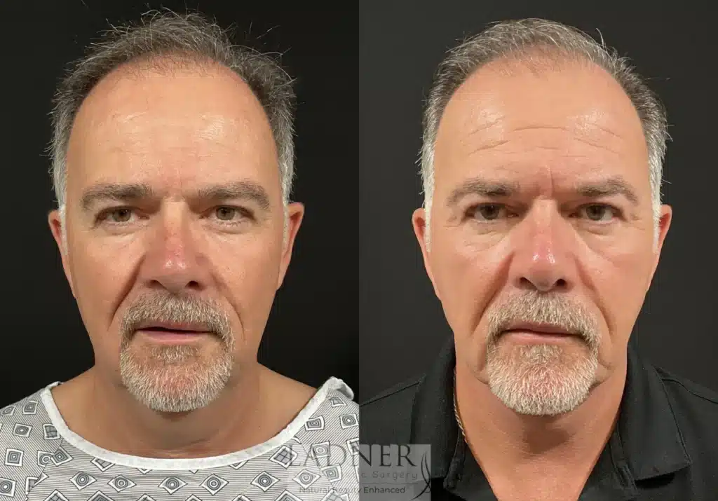 Before and After Image: Deep Plane Neck Lift & Facial Plastic Surgery for Men - front