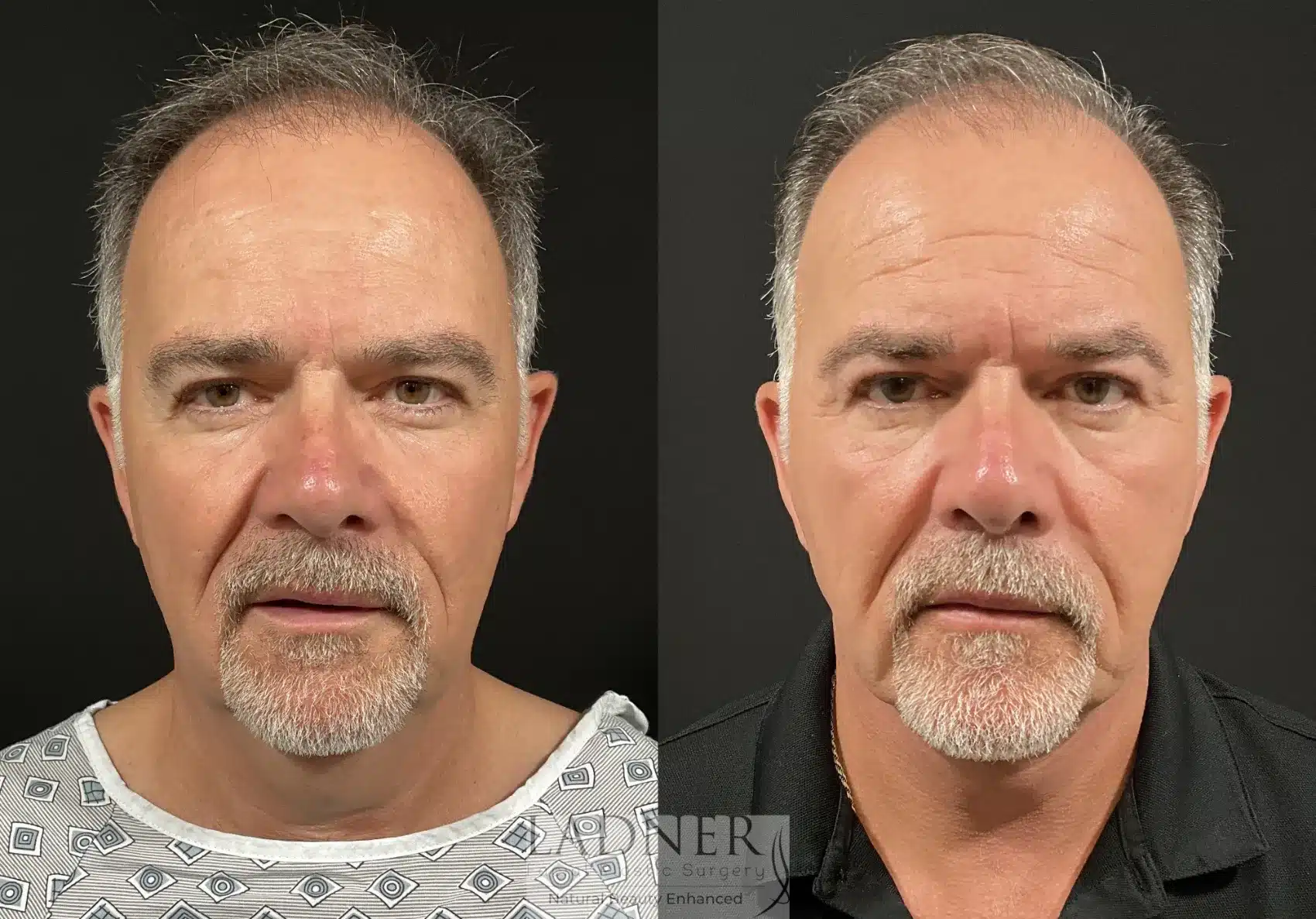 Before and After Image: Deep Plane Neck Lift - front