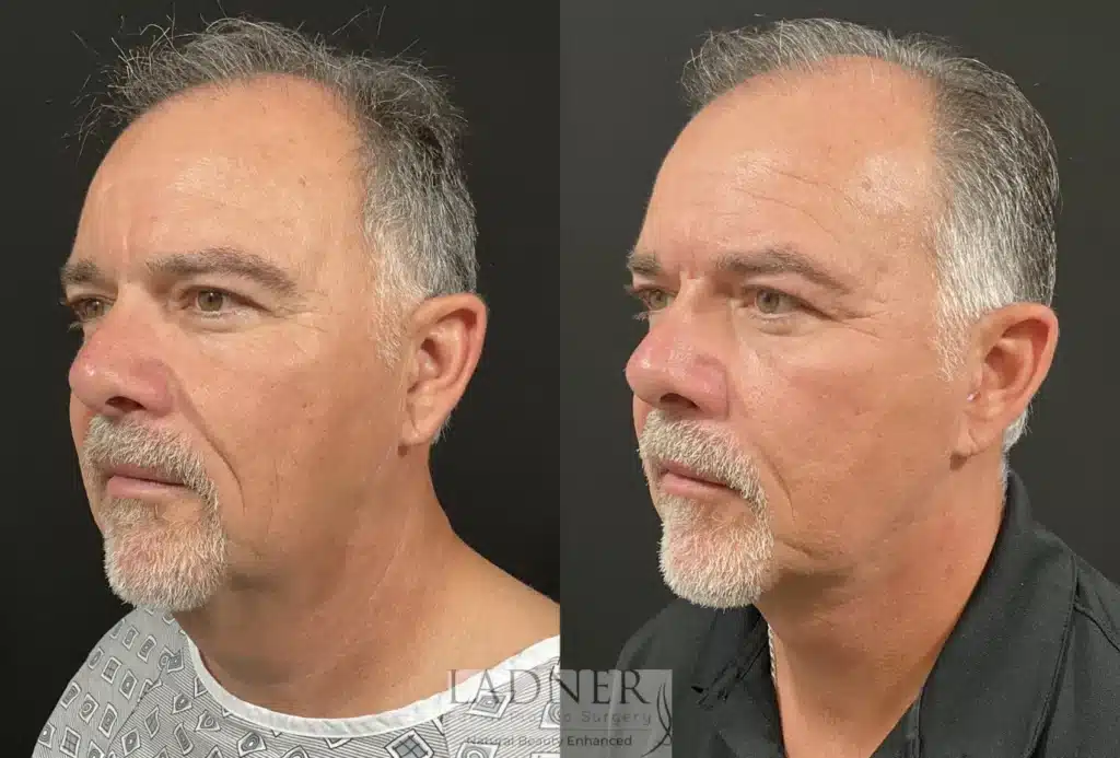 Before and After Image: Deep Plane Neck Lift & Facial Plastic Surgery for Men - left-front-oblique