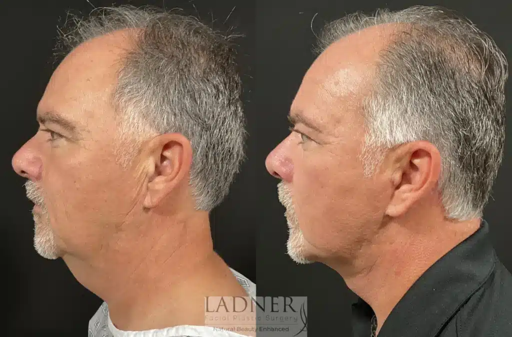 Before and After Image: Deep Plane Neck Lift & Facial Plastic Surgery for Men - left-side