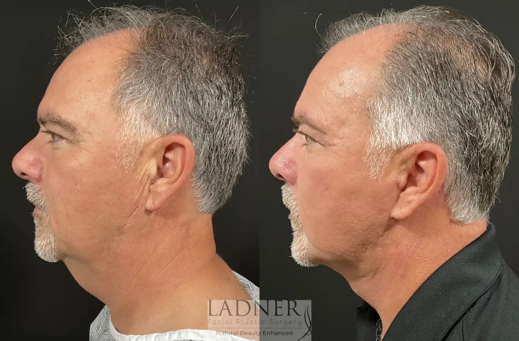 Before and After Image: Deep Plane Neck Lift - left-side