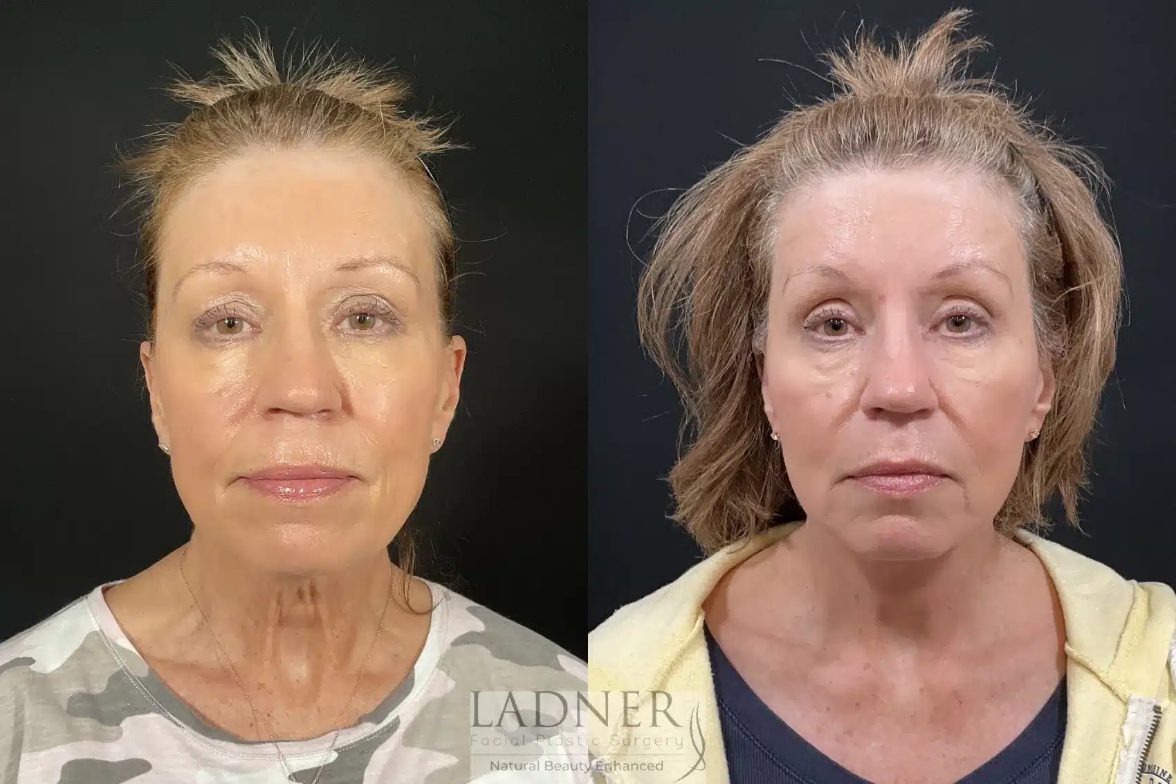 Before and After Image: Deep Plane Facelift/Neck Lift - front