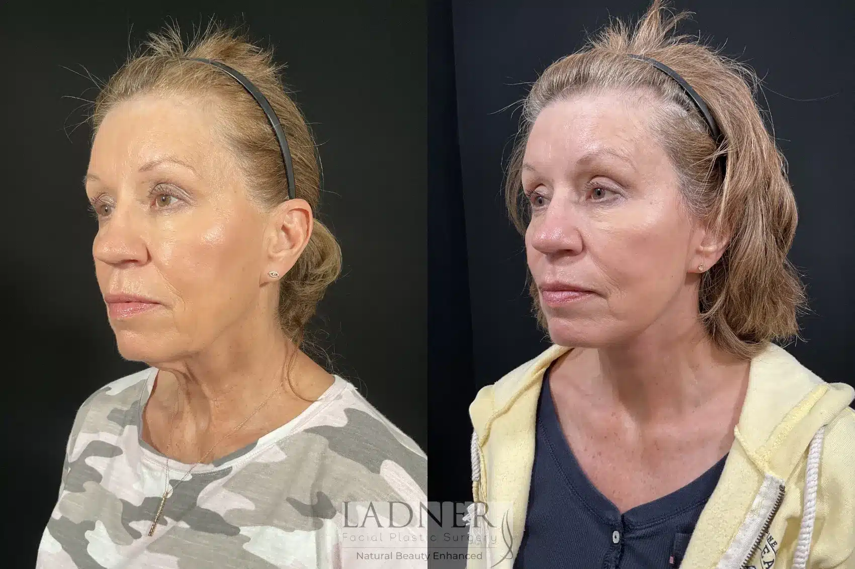 Before and After Image: Deep Plane Facelift/Neck Lift - left-front-oblique
