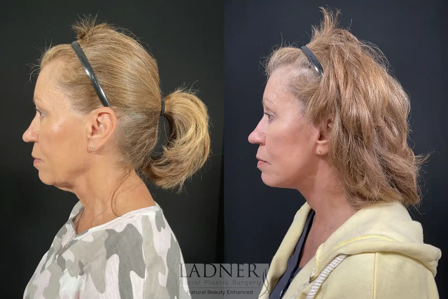 Before and After Image: Deep Plane Facelift/Neck Lift - left-side