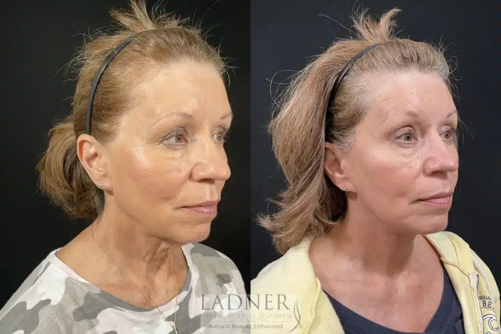 Before and After Image: Deep Plane Facelift/Neck Lift - right-front-oblique